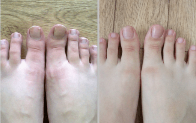 before and after nail fungus treatment