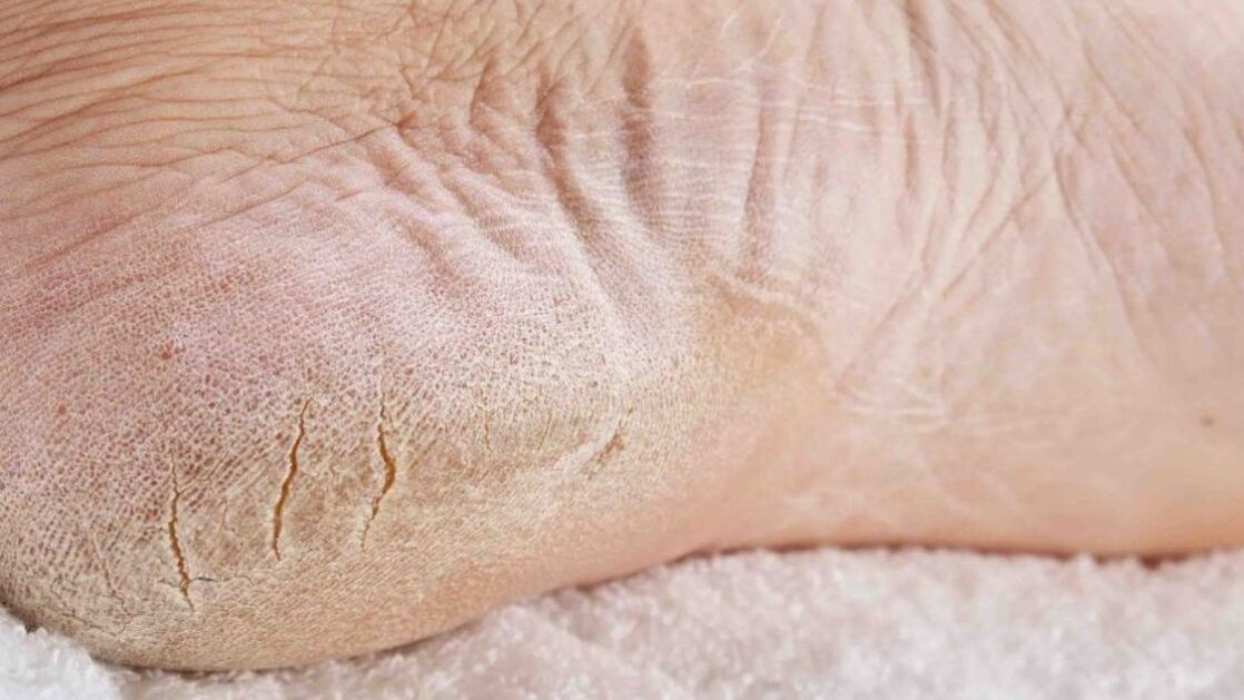 fungal infection in the foot