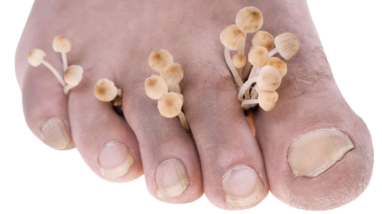 human foot fungus infection