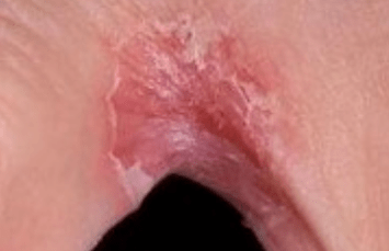 Fungus on the legs between the fingers