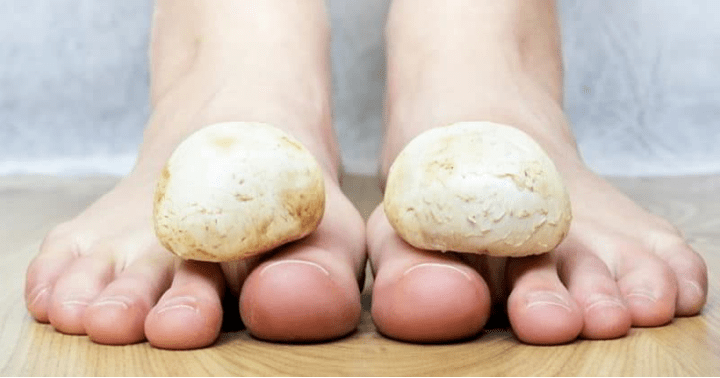 Fast fungus treatment in the legs at home