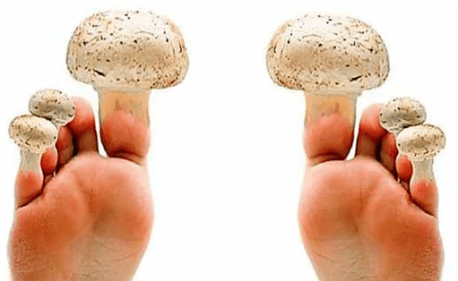 nail fungus