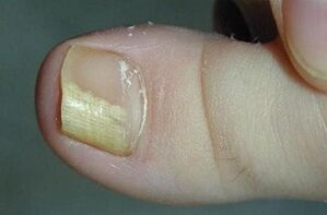 The reasons for the appearance of the fungus in the thumb