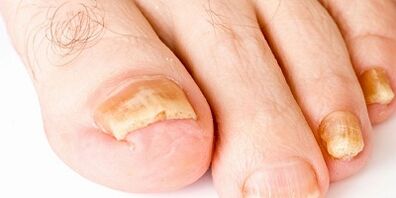How and how to heal nail fungus
