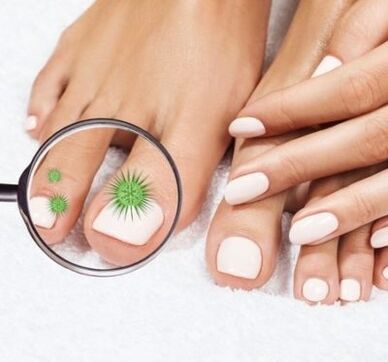Nail infection through a luxury