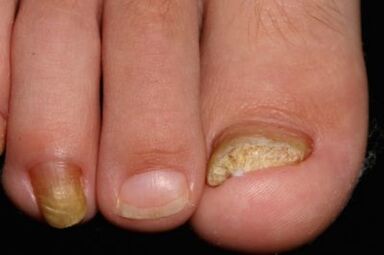 Nail mysis on the legs