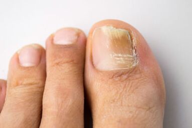 Ringworm caused by yeast microorganisms