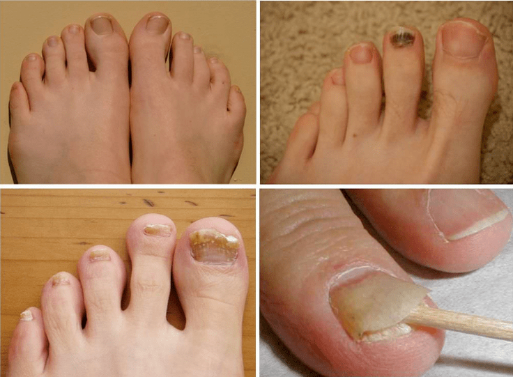 Nail fungus signs