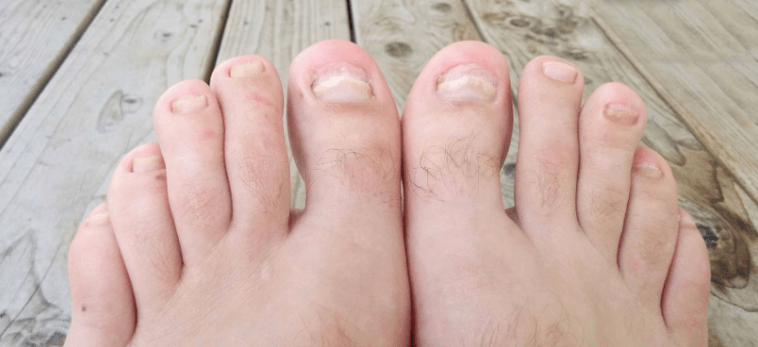 Nail fungus