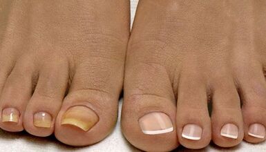 The causes of the appearance of the fungus on the nails
