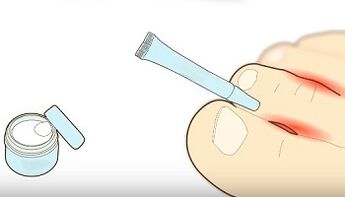 how to treat toe fungus