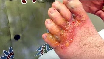 toe fungus symptoms