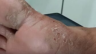 types and forms of toe fungus