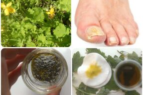 folk remedies for nail fungus