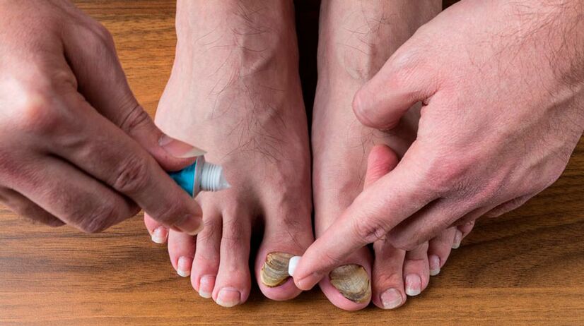 Applying antifungal cream to toenails to treat onychomycosis